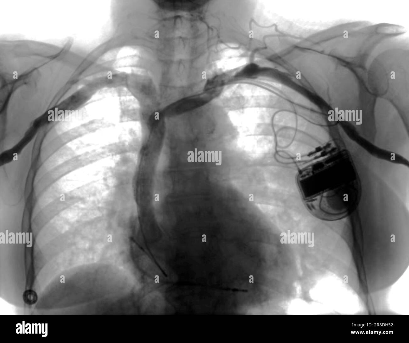 Implantable Cardioverter Defibrillator X Ray