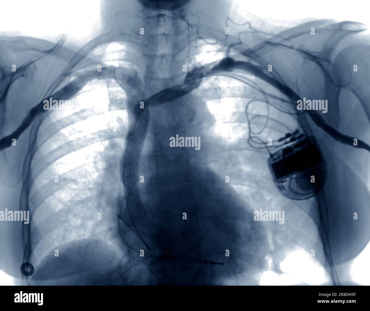 Cardiac defibrillator. Coloured Xray of the chest of a 55 year old