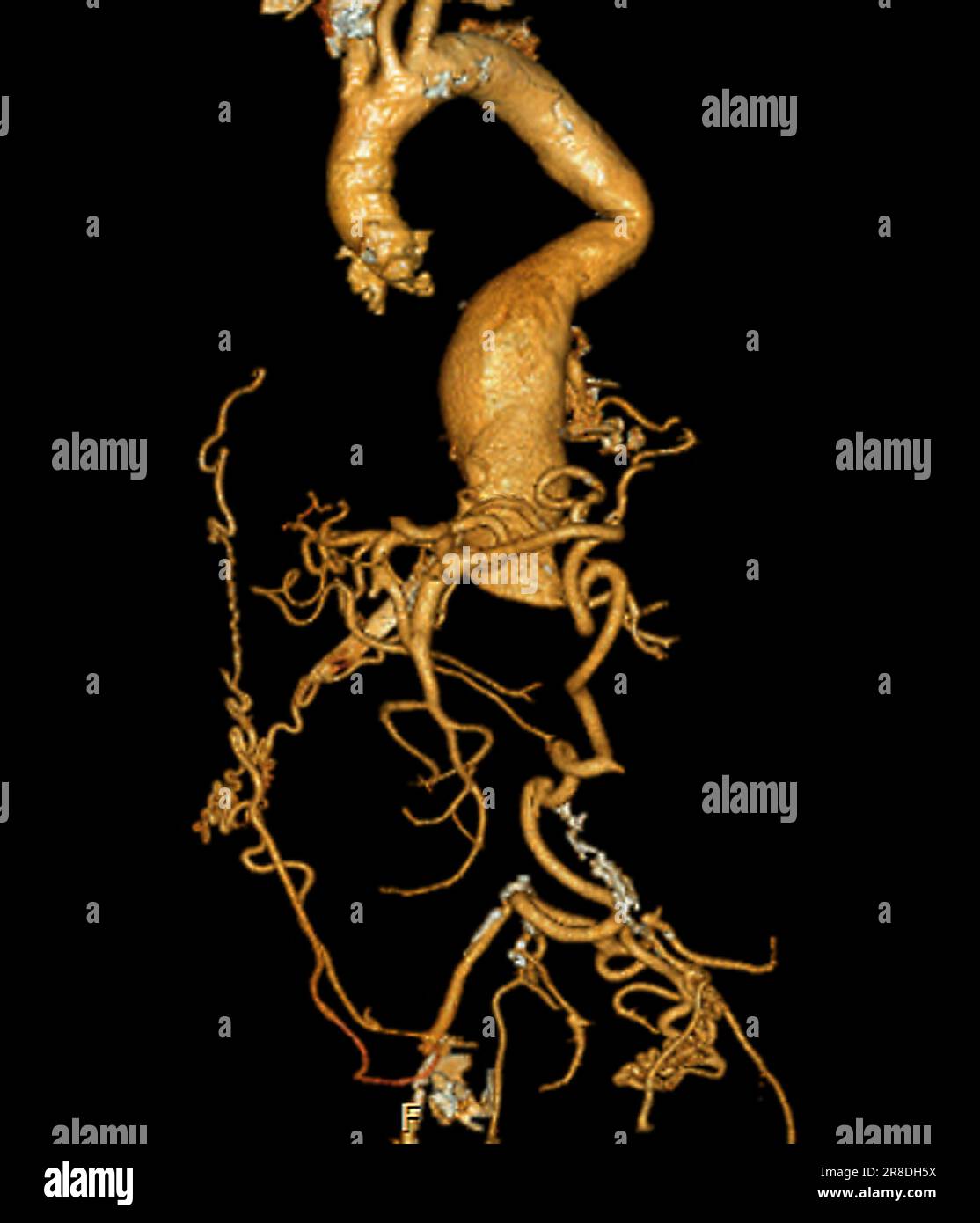 Abdominal Aortic Aneurysm CT Scan Stock Photo Alamy medcomic-what-s-new-hhsl