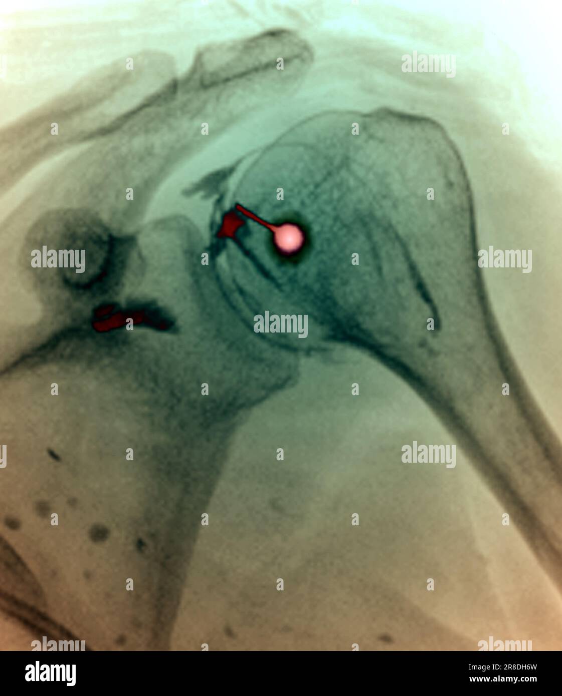 Coloured Xray of a corticosteroid drug being injected into the shoulder of a 51 year old male