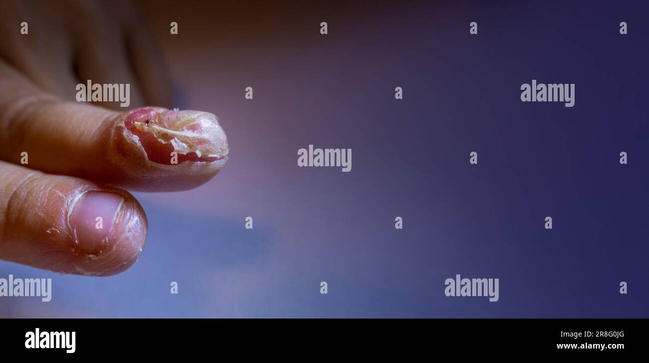 finger swollen with inflammation due to Nail ripped infection children