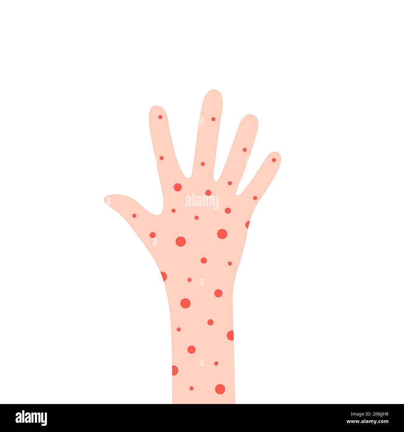 cartoon hand with rash like allergy Stock Vector