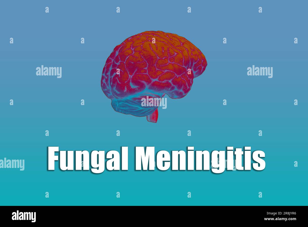 Background of fungal meningitis,Meningitis symptoms,Bacterial meningitis Stock Photo