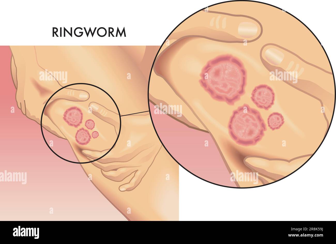 Medical illustration of a female leg affected by ringworm, with magnified detail. Stock Vector
