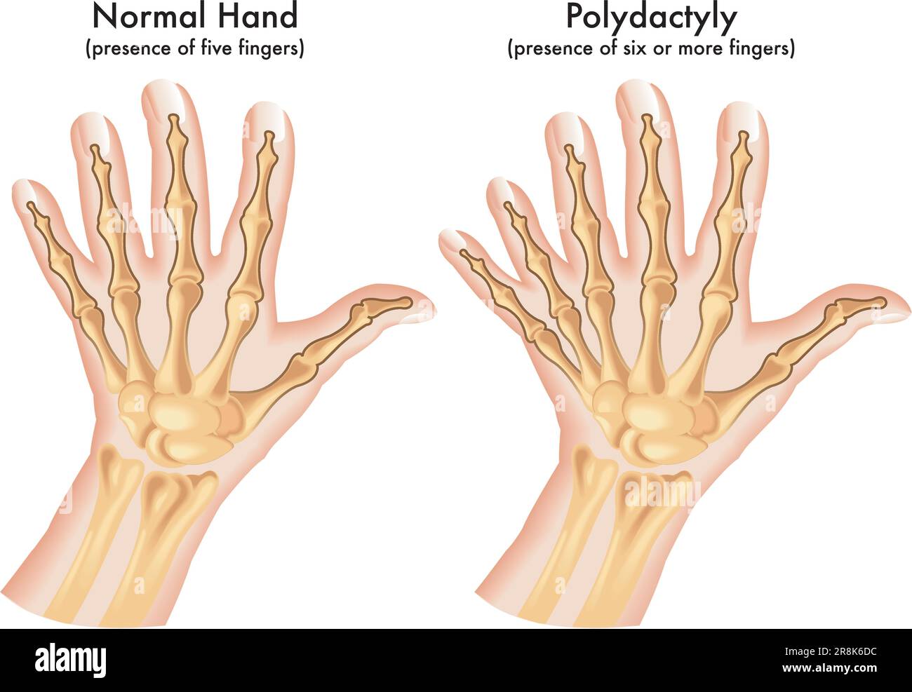 Medical illustration of a hand afflicted with Polydactyly, a congenital abnormality characterized by the presence of six or more fingers. Stock Vector