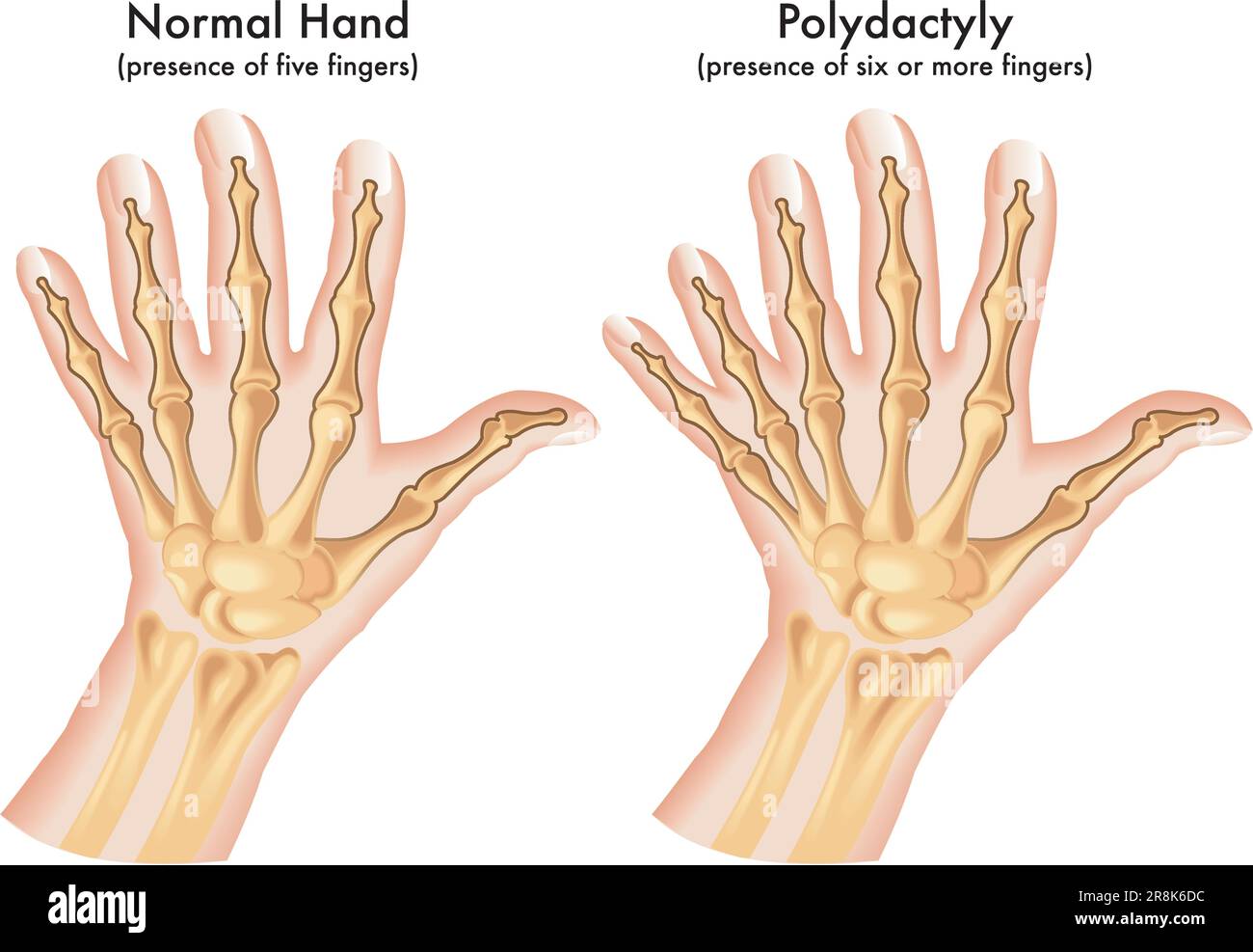 People With Extra Fingers People With Extra Fingers