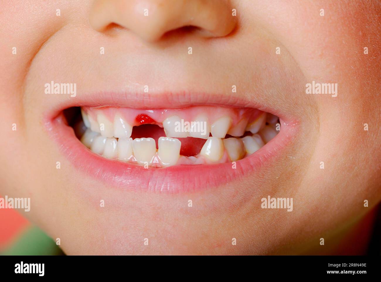 Child with gaps between the teeth, gap between the teeth, gap between the teeth, milk tooth