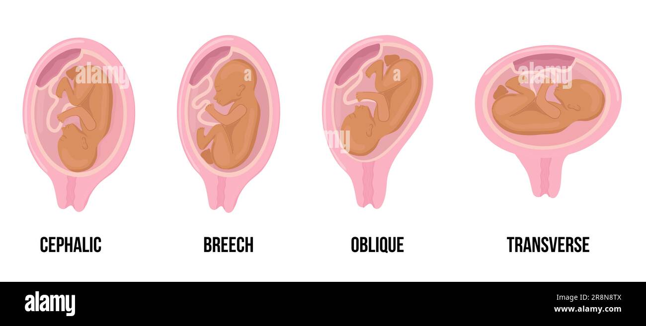 Latin arabian brown skin baby. Different wrong baby positions in uterus during pregnancy. Cephalic, Breech, transverse, Oblique lies. Colored medical Stock Vector