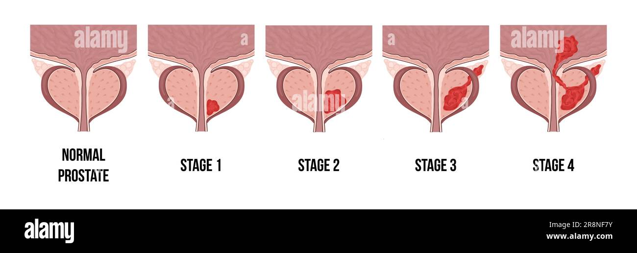 Medical diagram of 4 stages of prostate cancer. tumor grows and into neighboring
