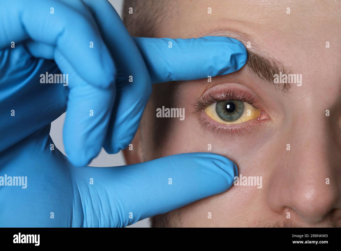 Doctor checking yellow eyes of patient on light grey background