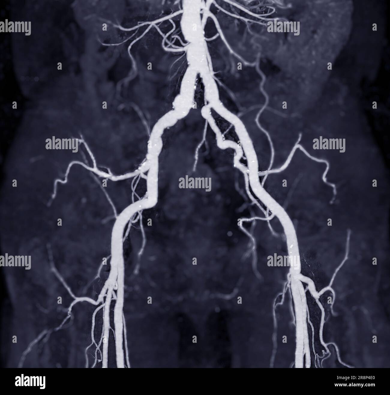 CTA femoral artery run off image of femoral artery for diagnostic  Acute or Chronic Peripheral Arterial Disease. Stock Photo