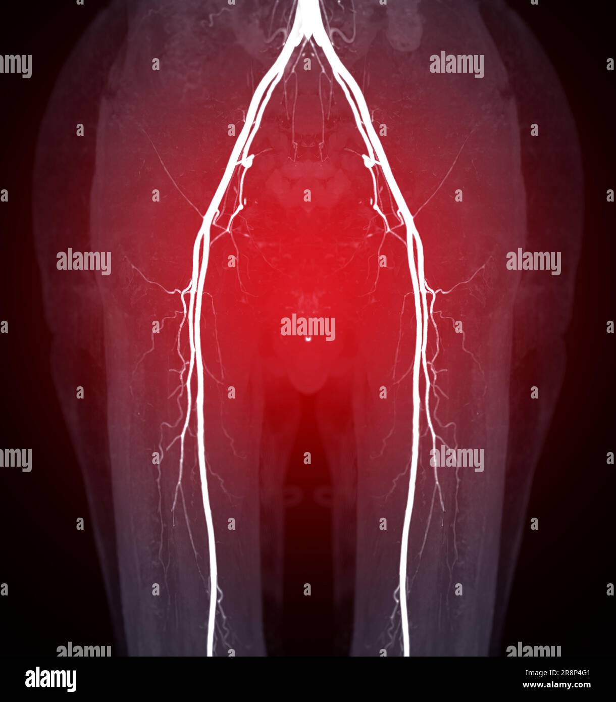 CTA femoral artery run off image of femoral artery for diagnostic Acute ...