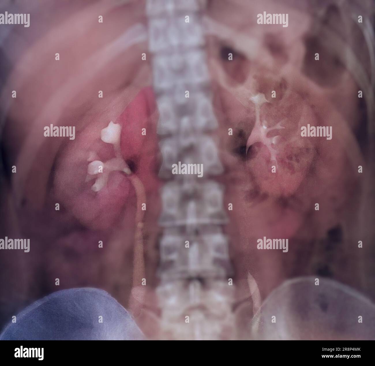Pylelogram Intravenous pyelogram or I.V.P is an X-ray exam of urinary tract after ...