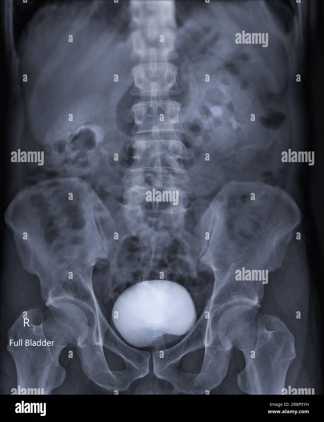 Intravenous pyelogram or I.V.P is an X-ray exam of urinary tract after ...
