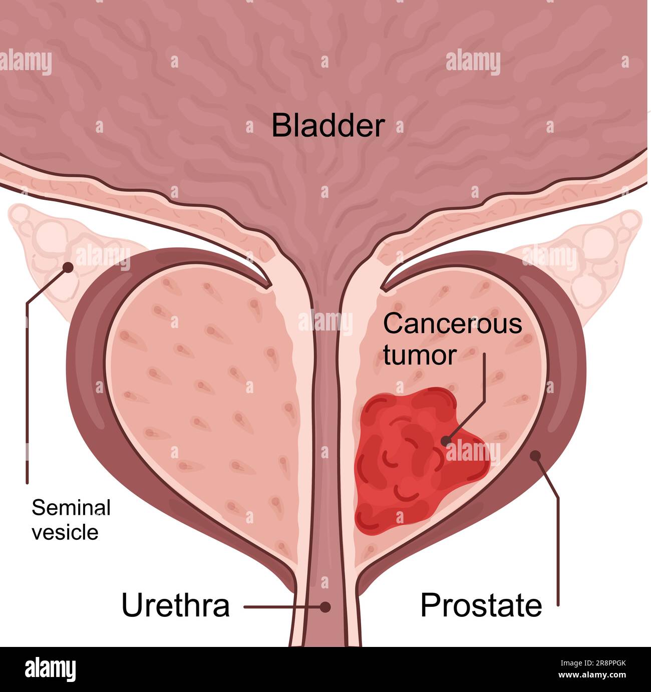 Medical diagram of 2 stages of prostate cancer. tumor grows and penetrates into neighboring organs and tissues. vector illustration. Stock Vector