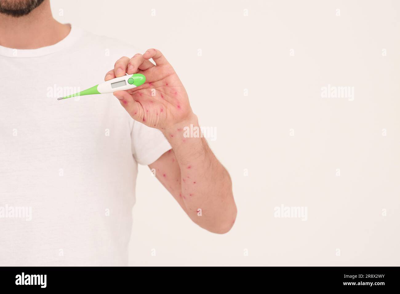 Man with rash holding thermometer on beige background, space for text ...