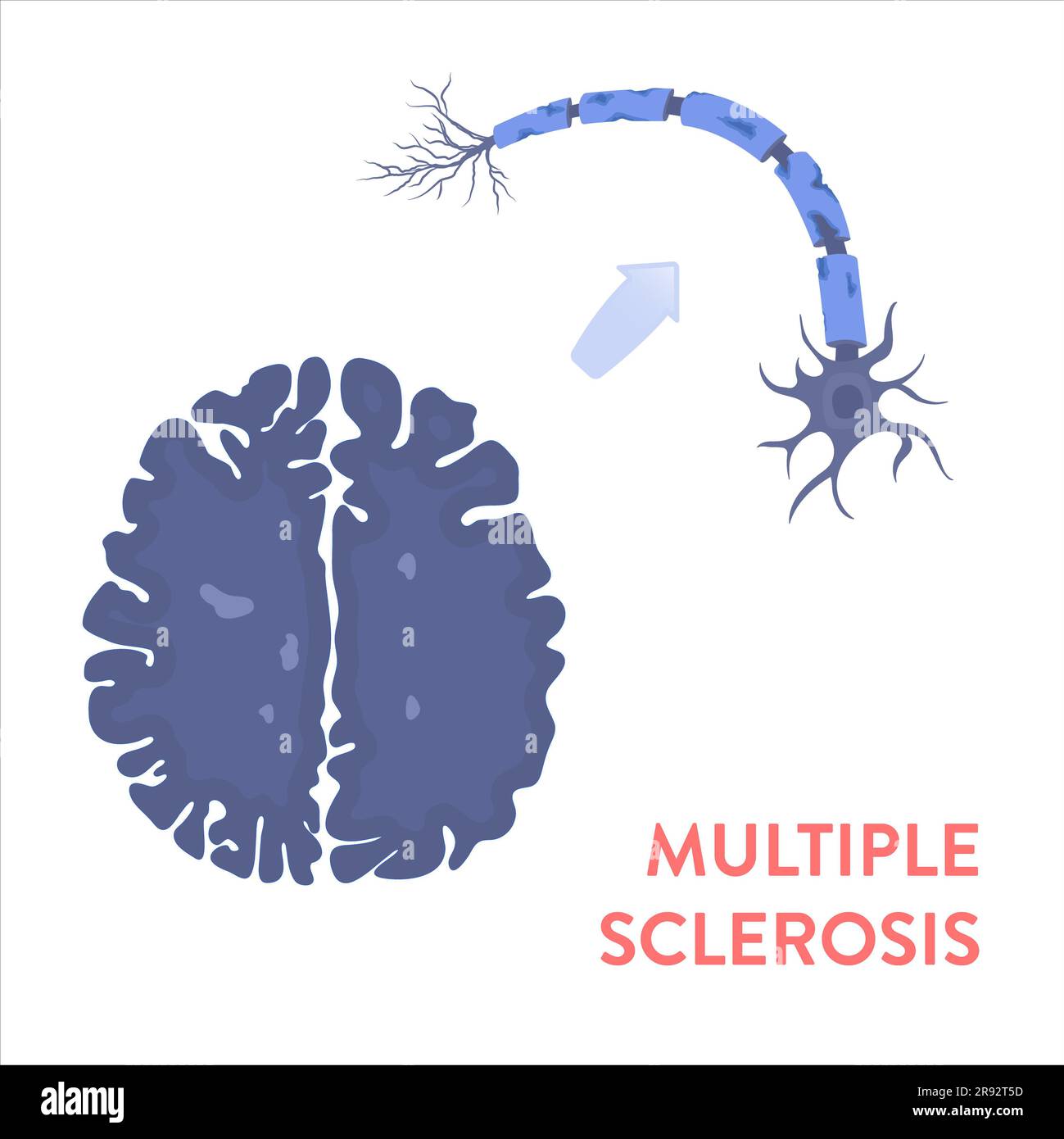 Multiple sclerosis, conceptual illustration Stock Photo - Alamy