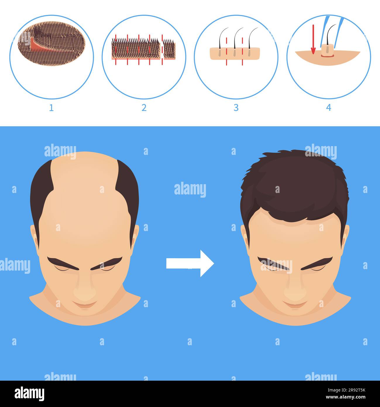 FUT hair transplantation, illustration Stock Photo