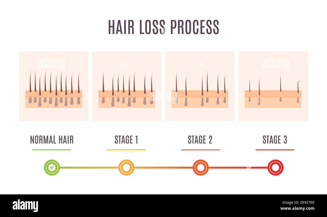 Hair loss process, conceptual illustration Stock Photo