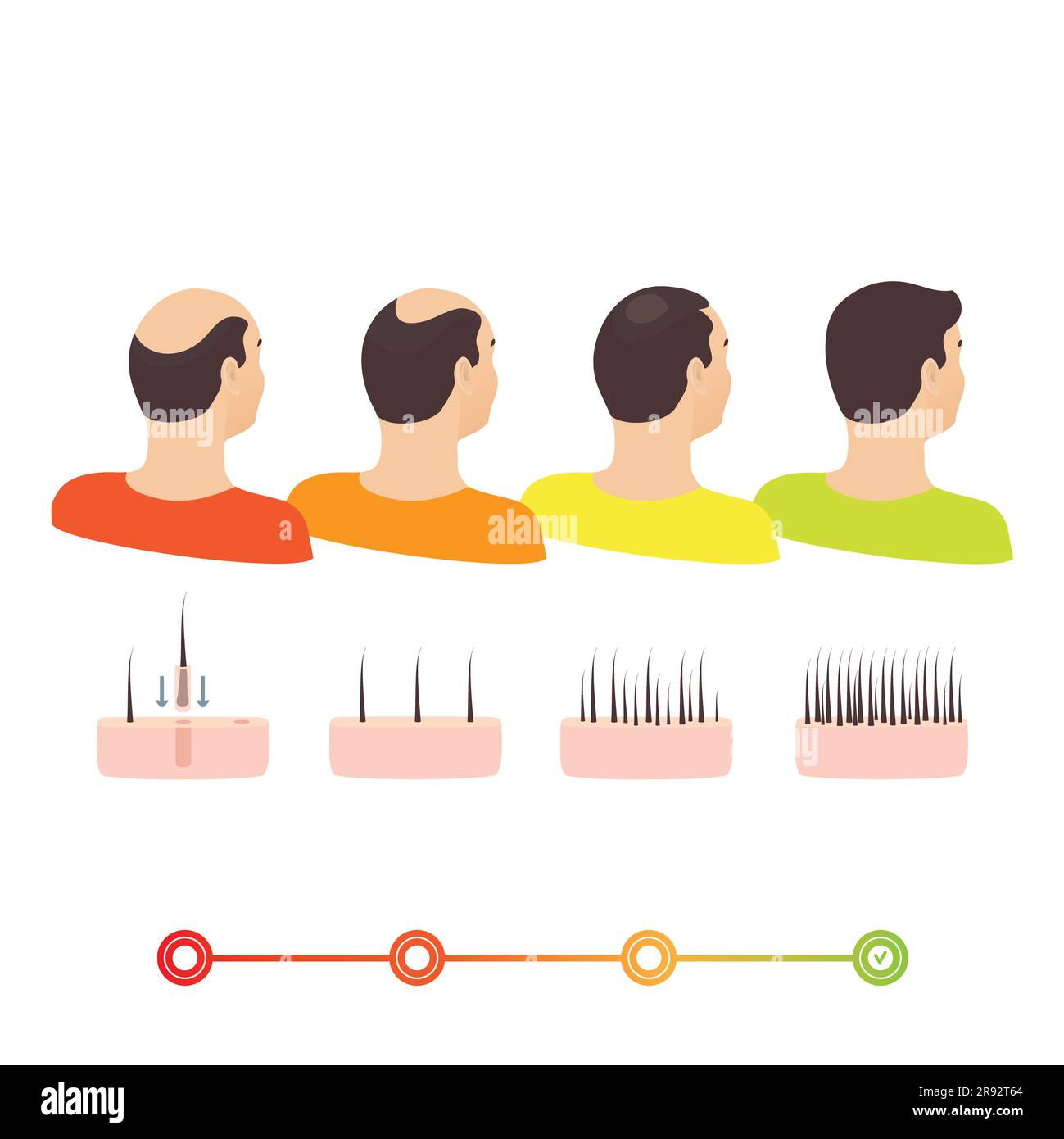 Hair transplantation, illustration Stock Photo