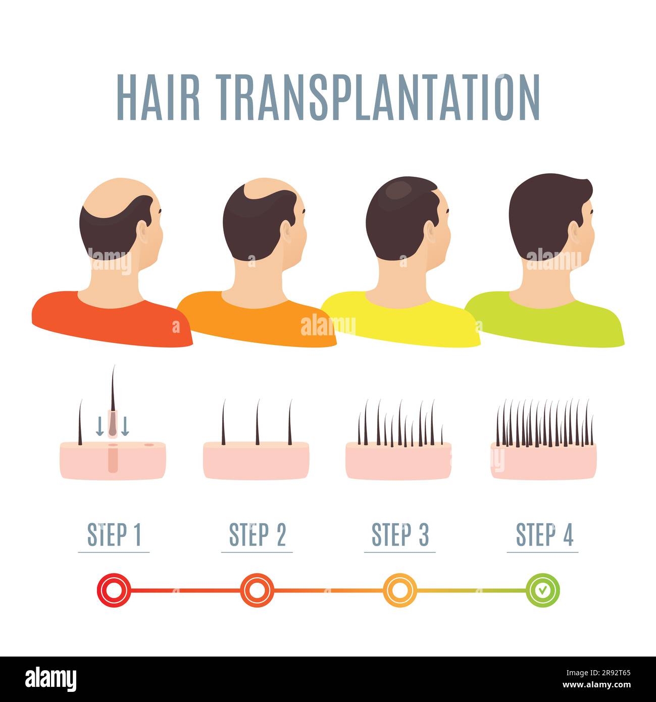 Hair transplantation, illustration Stock Photo