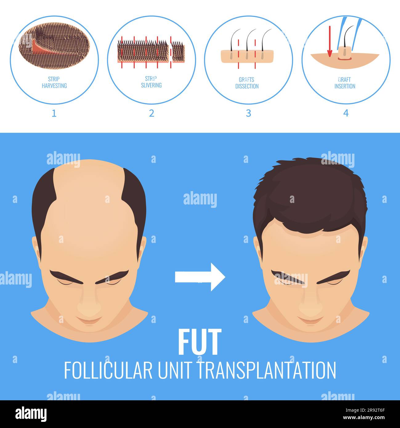 FUT hair transplantation, illustration Stock Photo