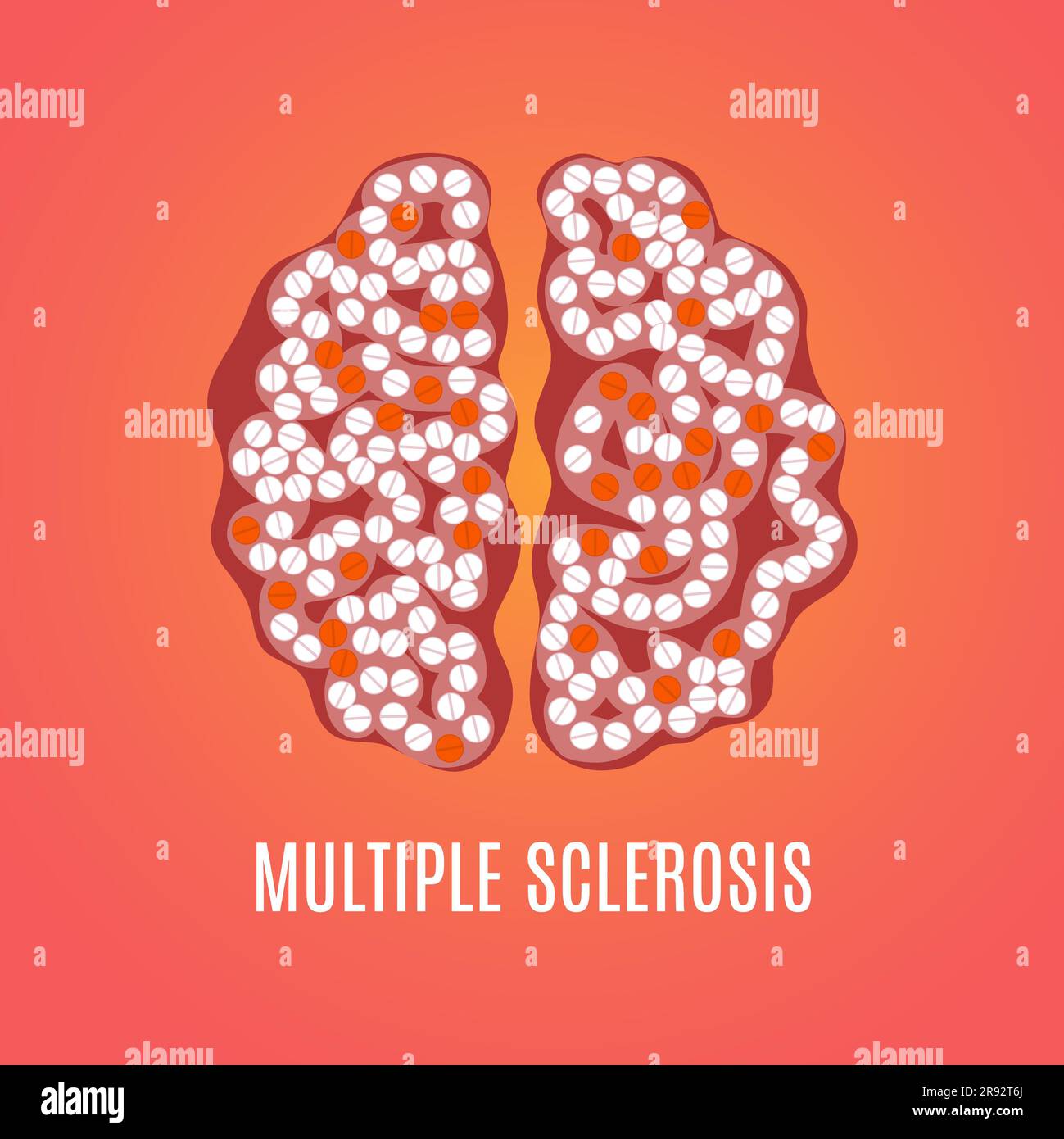 Multiple sclerosis, conceptual illustration Stock Photo Alamy