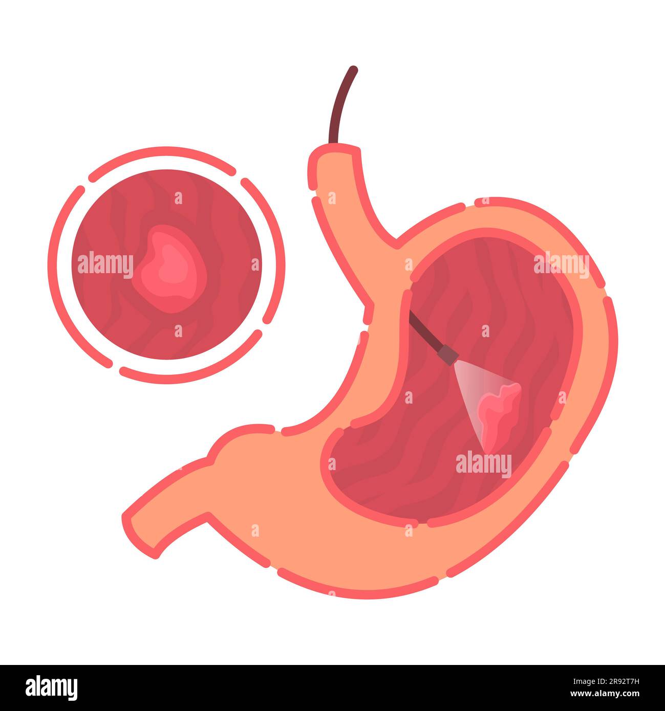 Stomach gastroscopy, illustration Stock Photo