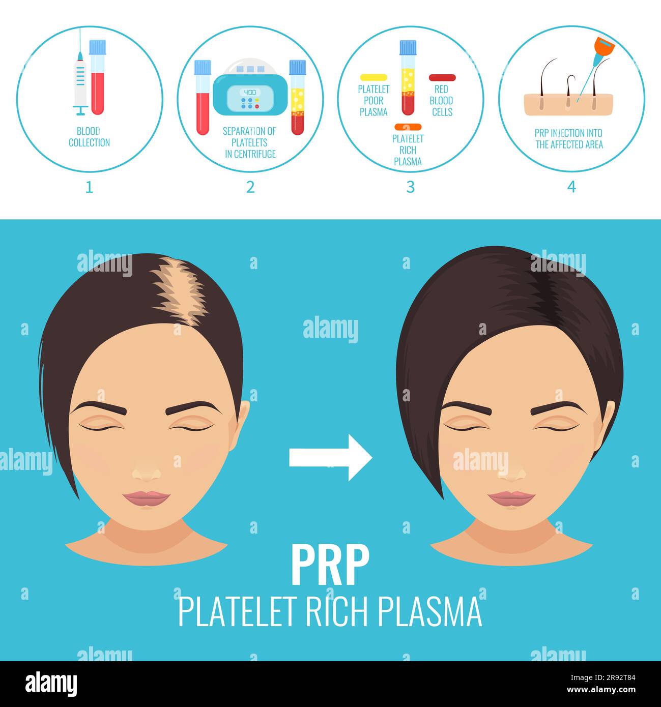 PRP hair loss treatment, illustration Stock Photo