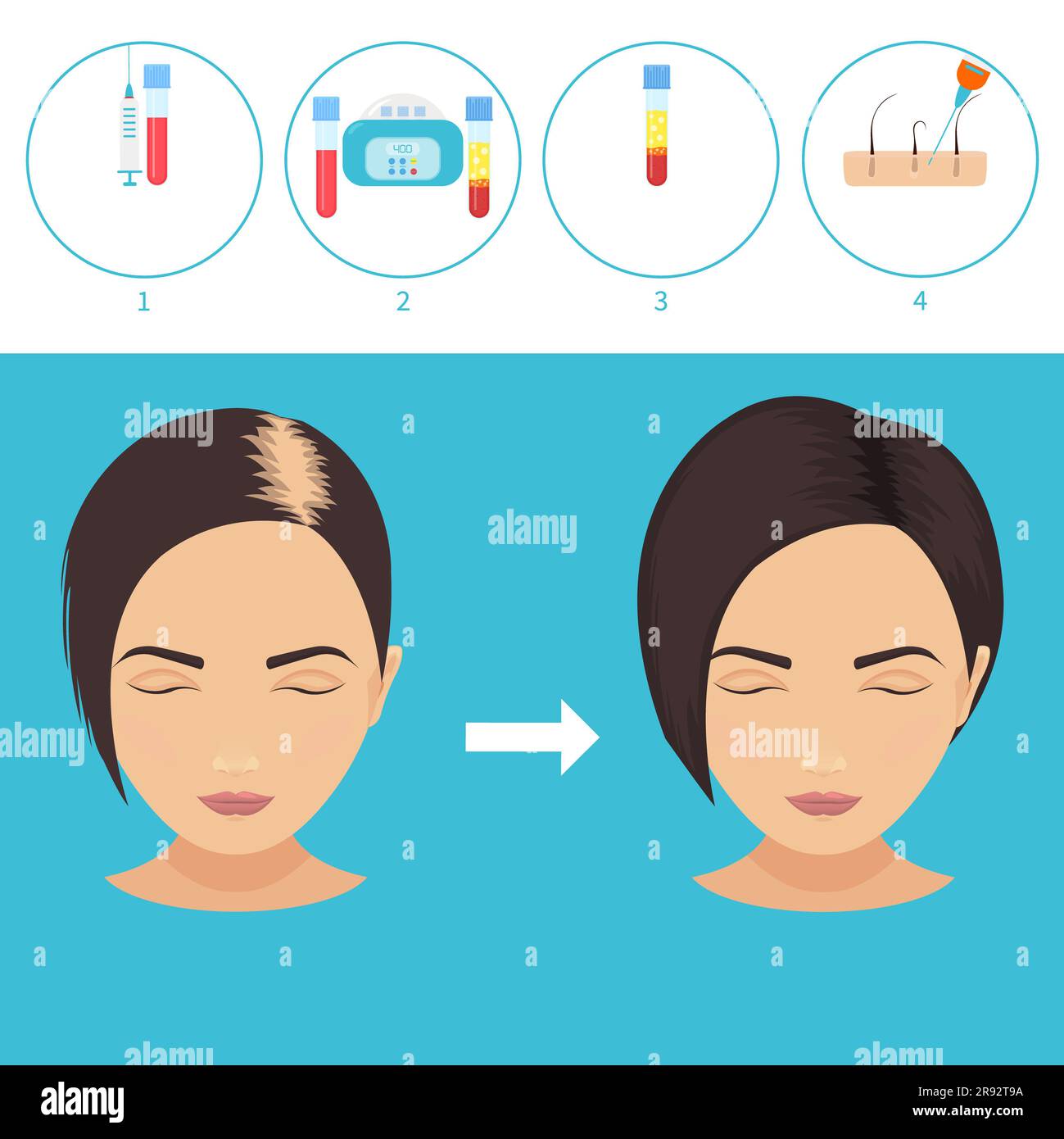 PRP hair loss treatment, illustration Stock Photo