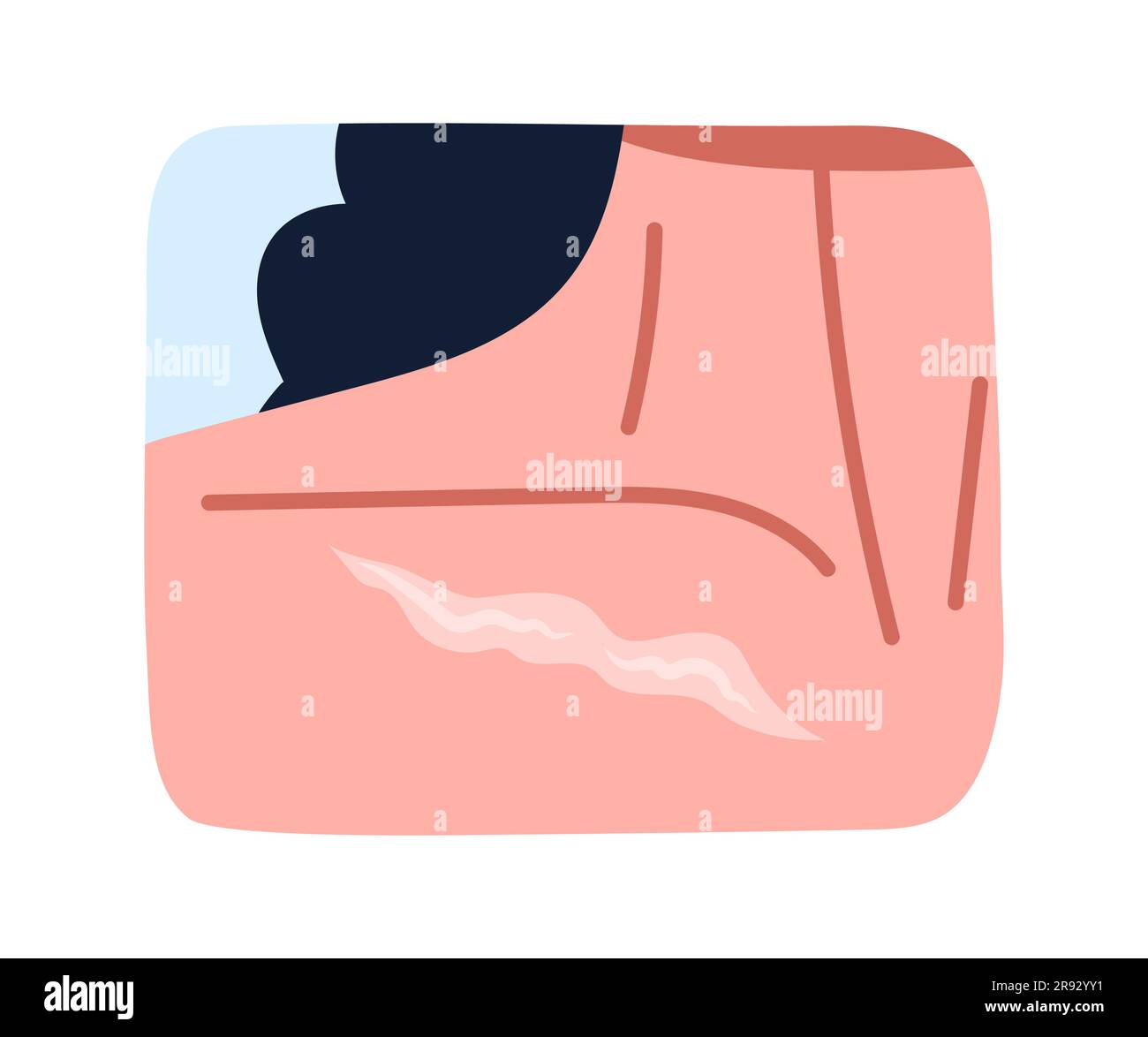 Chest scar hires stock photography and images Alamy