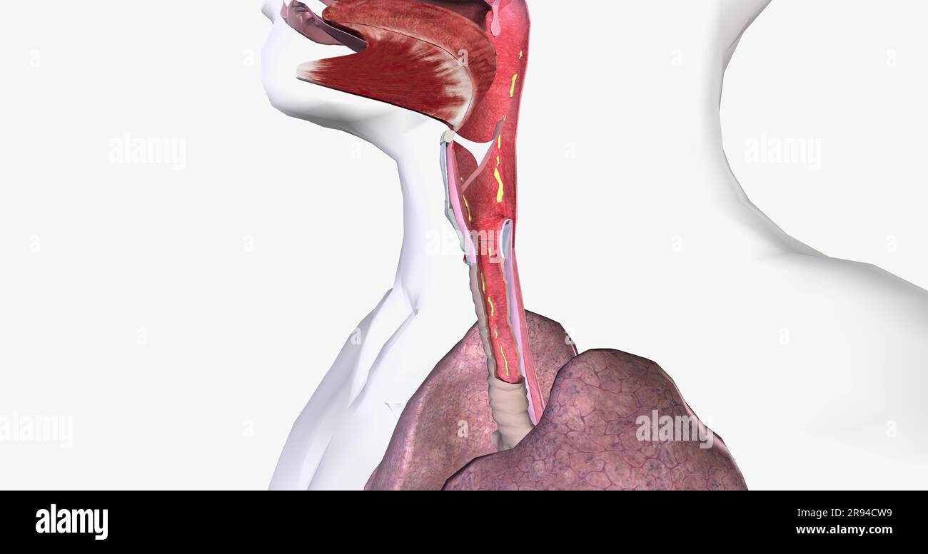 Croup is breathing difficulty and a barking cough. Croup is due to