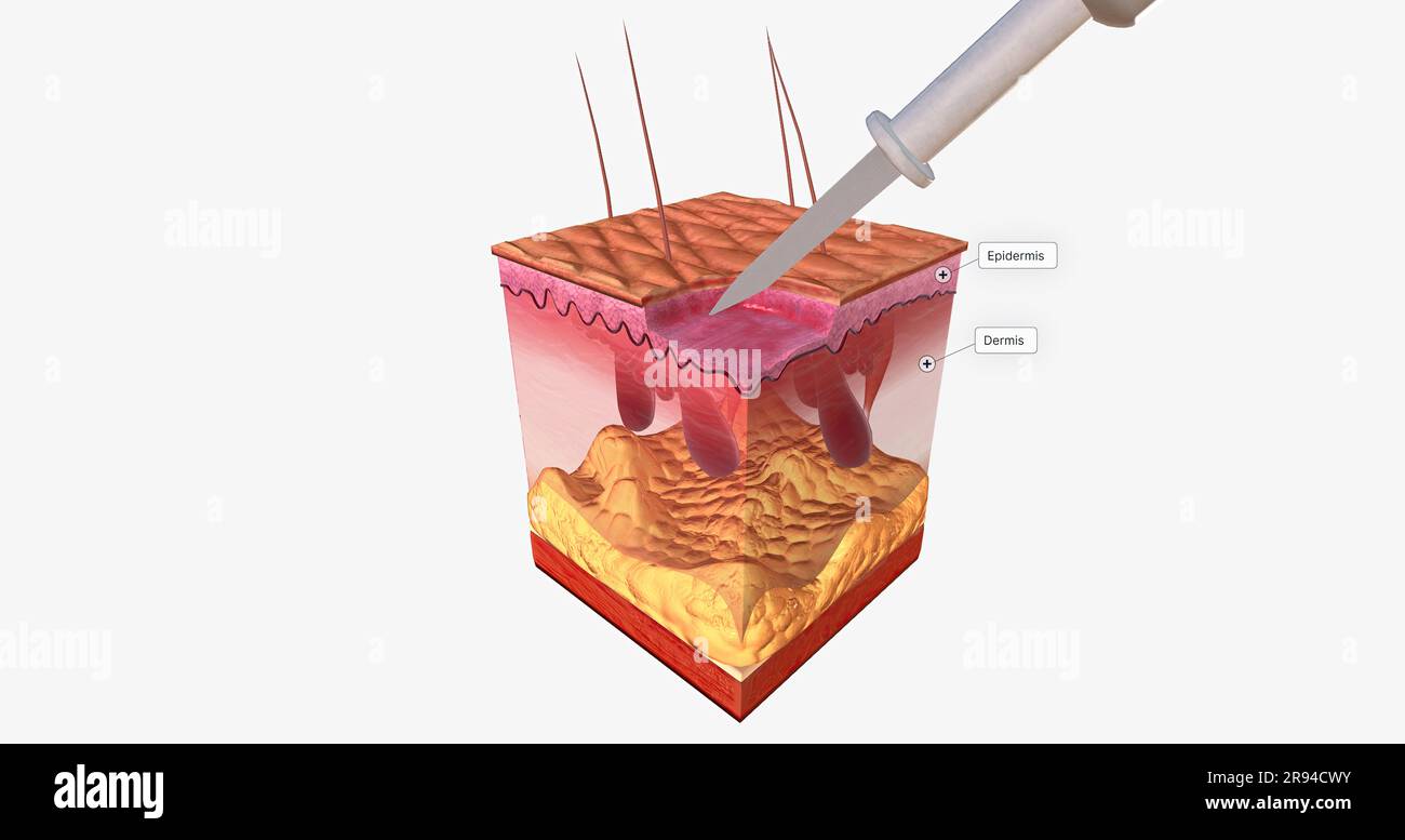 The Curettage and Electrodesiccation Close Up 3D rendering Stock Photo