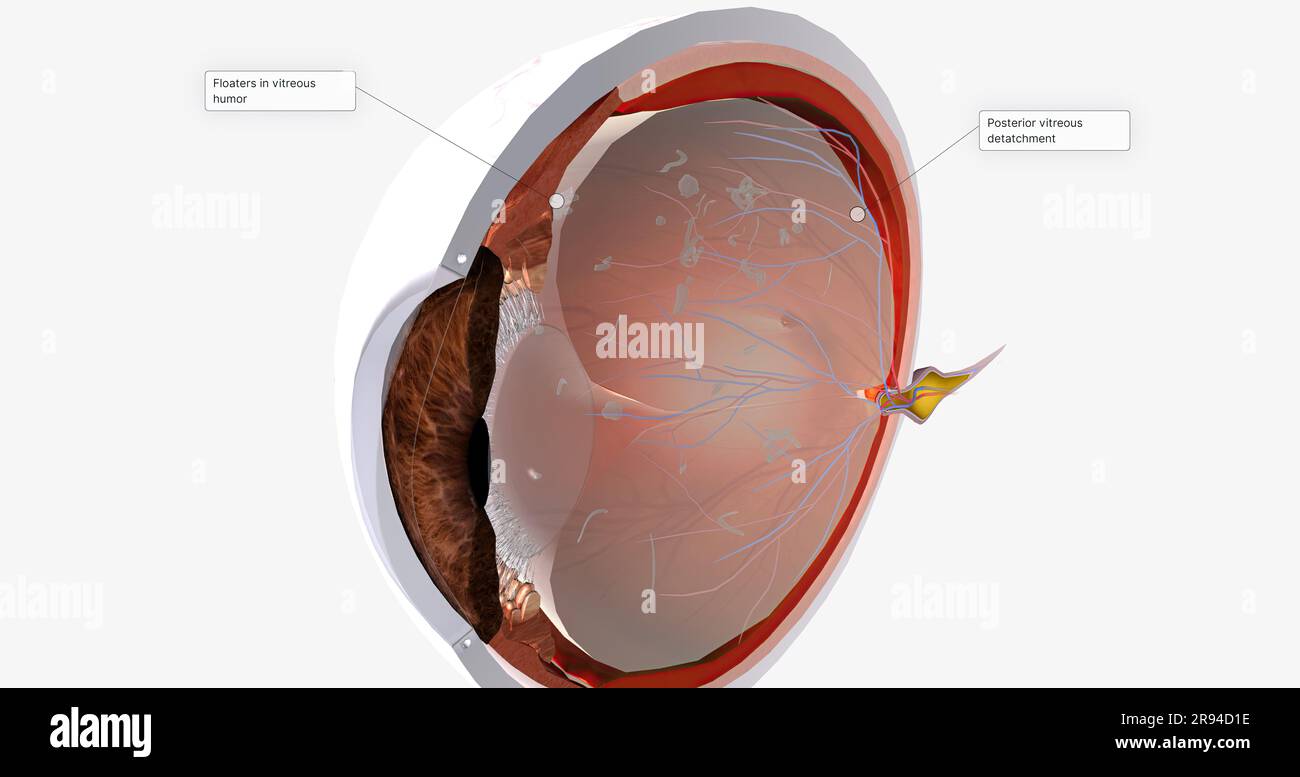 Floaters are small spots in your field of vision. 3D rendering Stock