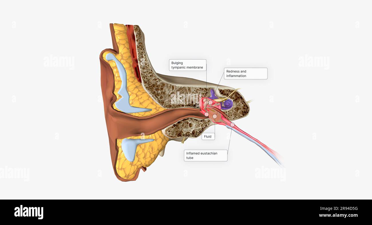Acute otitis media is an infection and inflammation of the middle ear