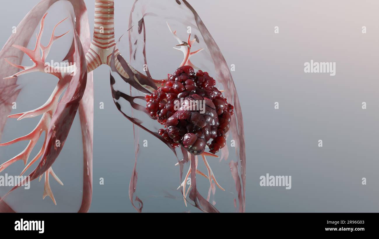 Pneumonia illness, healthy lungs and disease lungs, Human Lungs cancer, Cigarette smokers Lung disease, cancerous malignant tumor growing and spreadin Stock Photo