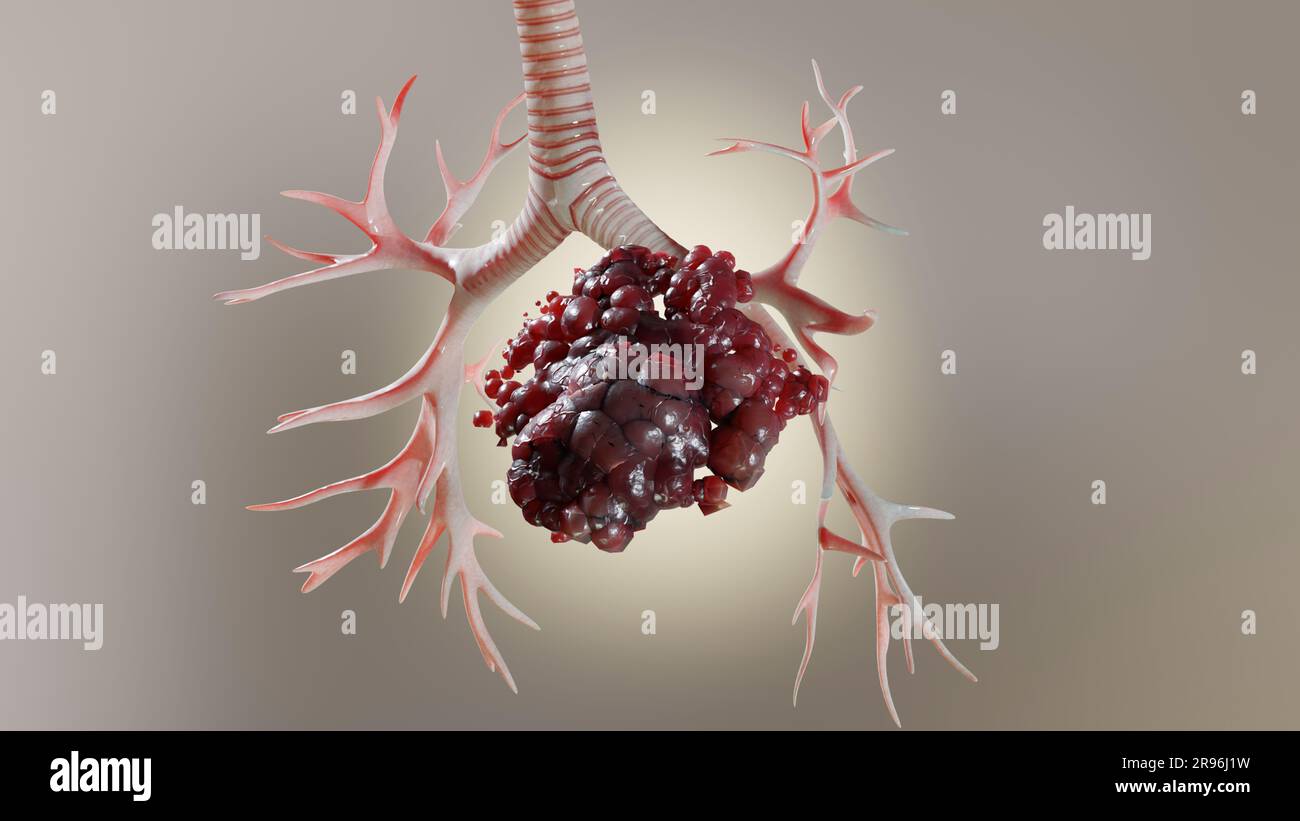 Pneumonia illness, healthy lungs and disease lungs, Human Lungs cancer, Cigarette smokers Lung disease, cancerous malignant tumor growing and spreadin Stock Photo