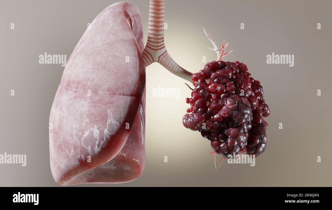 Pneumonia illness, healthy lungs and disease lungs, Human Lungs cancer, Cigarette smokers Lung disease, cancerous malignant tumor growing and spreadin Stock Photo
