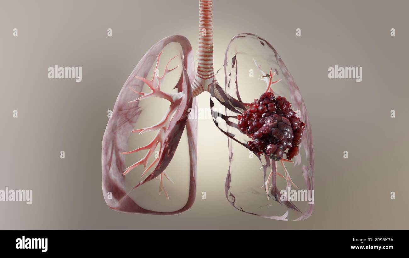 Pneumonia illness, healthy lungs and disease lungs, Human Lungs cancer, Cigarette smokers Lung disease, cancerous malignant tumor growing and spreadin Stock Photo