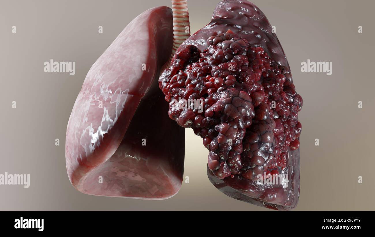 Pneumonia illness, healthy lungs and disease lungs, Human Lungs cancer,  Cigarette smokers Lung disease, cancerous malignant tumor growing and  spreadin Stock Photo