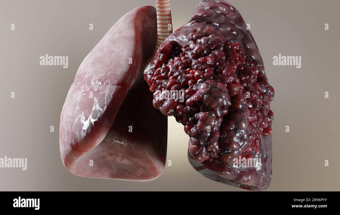 Pneumonia illness, healthy lungs and disease lungs, Human Lungs cancer, Cigarette smokers Lung disease, cancerous malignant tumor growing and spreadin Stock Photo