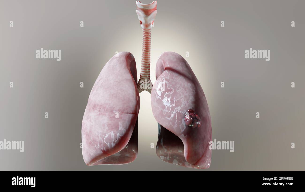 Pneumonia illness, healthy lungs and disease lungs, Human Lungs cancer, Cigarette smokers Lung disease, cancerous malignant tumor growing and spreadin Stock Photo