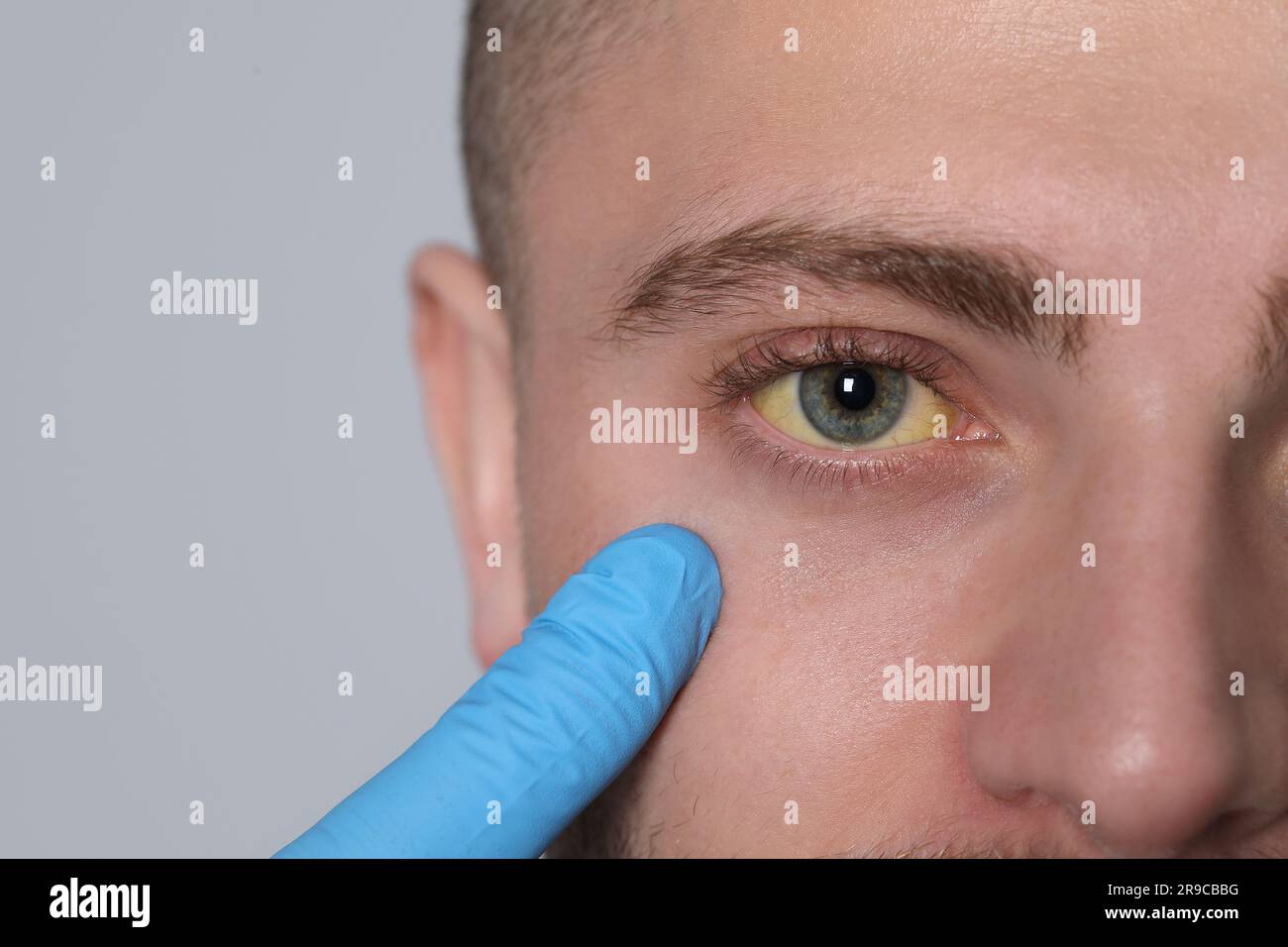 Doctor checking yellow eyes of patient on light grey background, closeup and space for text. Hepatitis symptom Stock Photo
