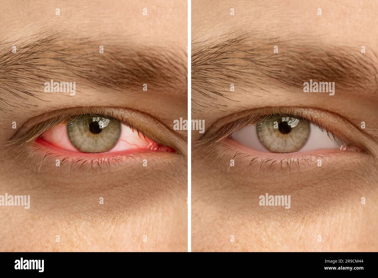 Collage with photos of man before and after conjunctivitis treatment