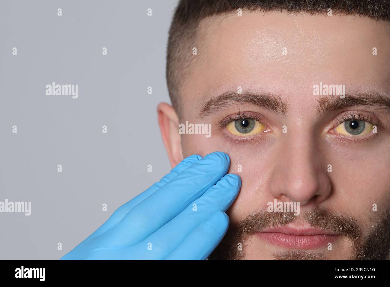 Doctor checking yellow eyes of patient on light grey background