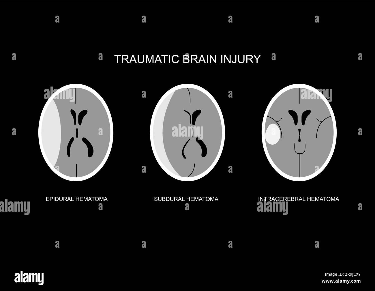 Ilustration of common CT imaging following traumatic brain injury. Epidural hematoma, acute subdural hematoma and intracerebral hematoma. Stock Vector