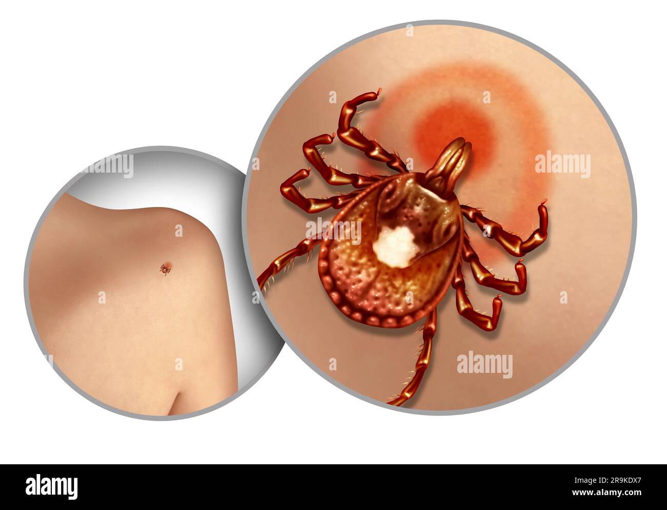 Lone Star Tick on the skin as a disease and infectious ticks spreading infection as a health danger with a bite of a parasite causing infections Stock Photo