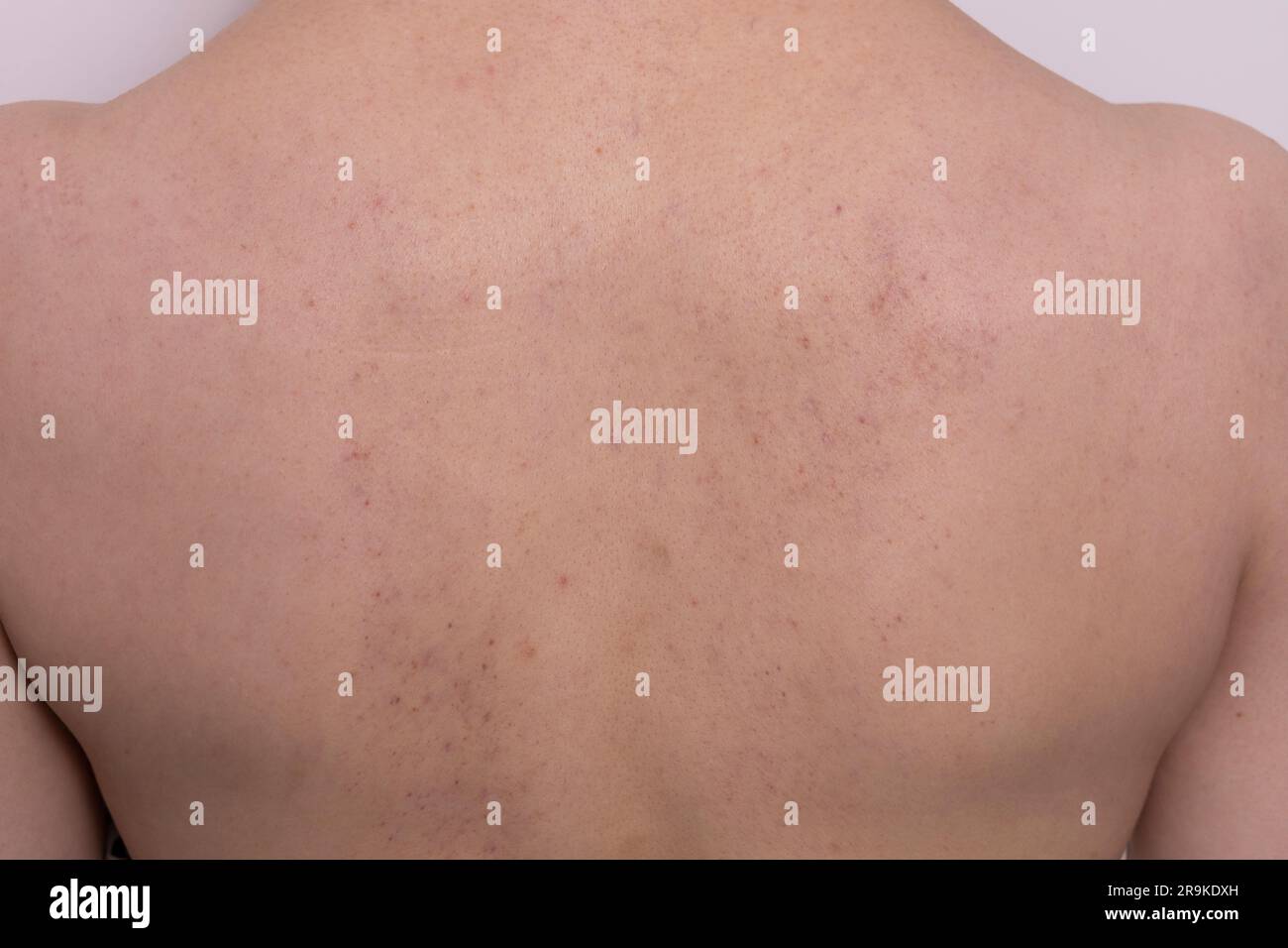 Close up bruises, broken capillaries after cupping, anti cellulite massage procedure on female