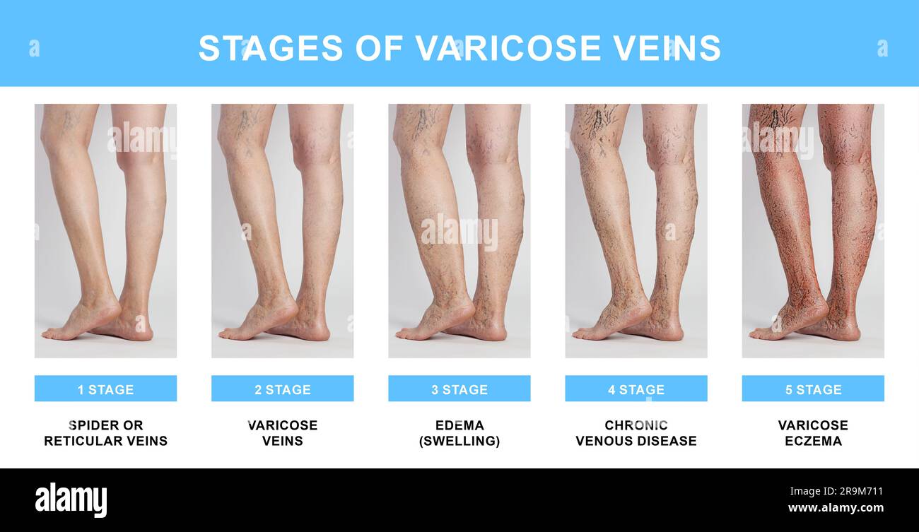Stages of varicose veins. Collage with photos of woman showing changes ...
