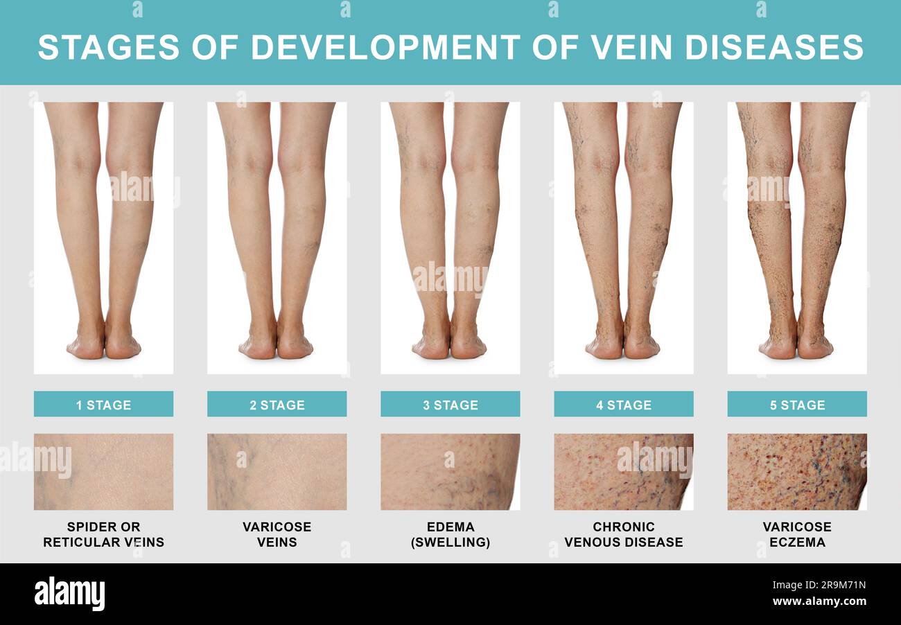 Stages of development of vein diseases. Photos of woman and zoomed skin